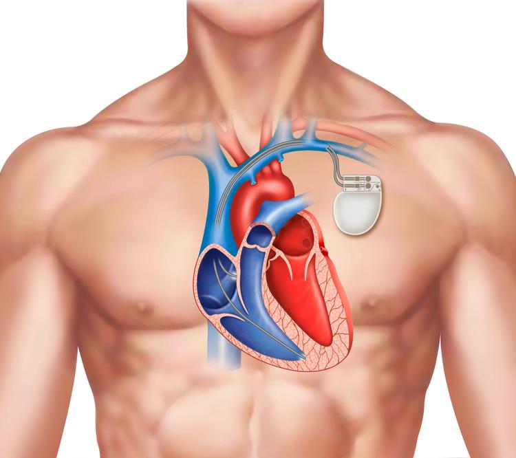 Nova diretriz sobre o uso de dispositivos cardíacos eletrônicos implantáveis acaba de ser publicada