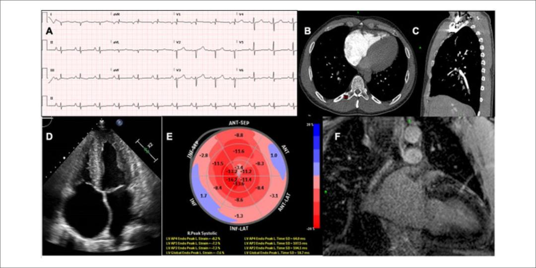 Pulmonary Embolism and Light Chain Cardiac Amyloidosis with Progression to Heart Transplant