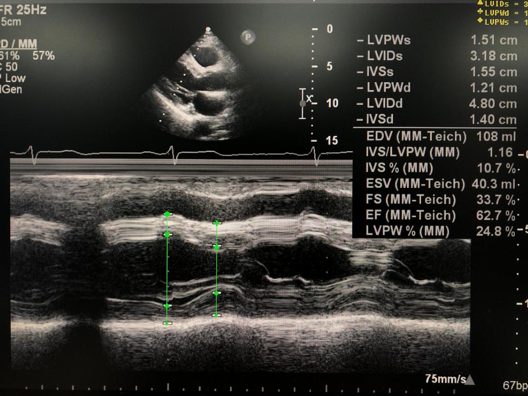 One-Dimensional Echocardiography: Still Needed or Already Outdated?