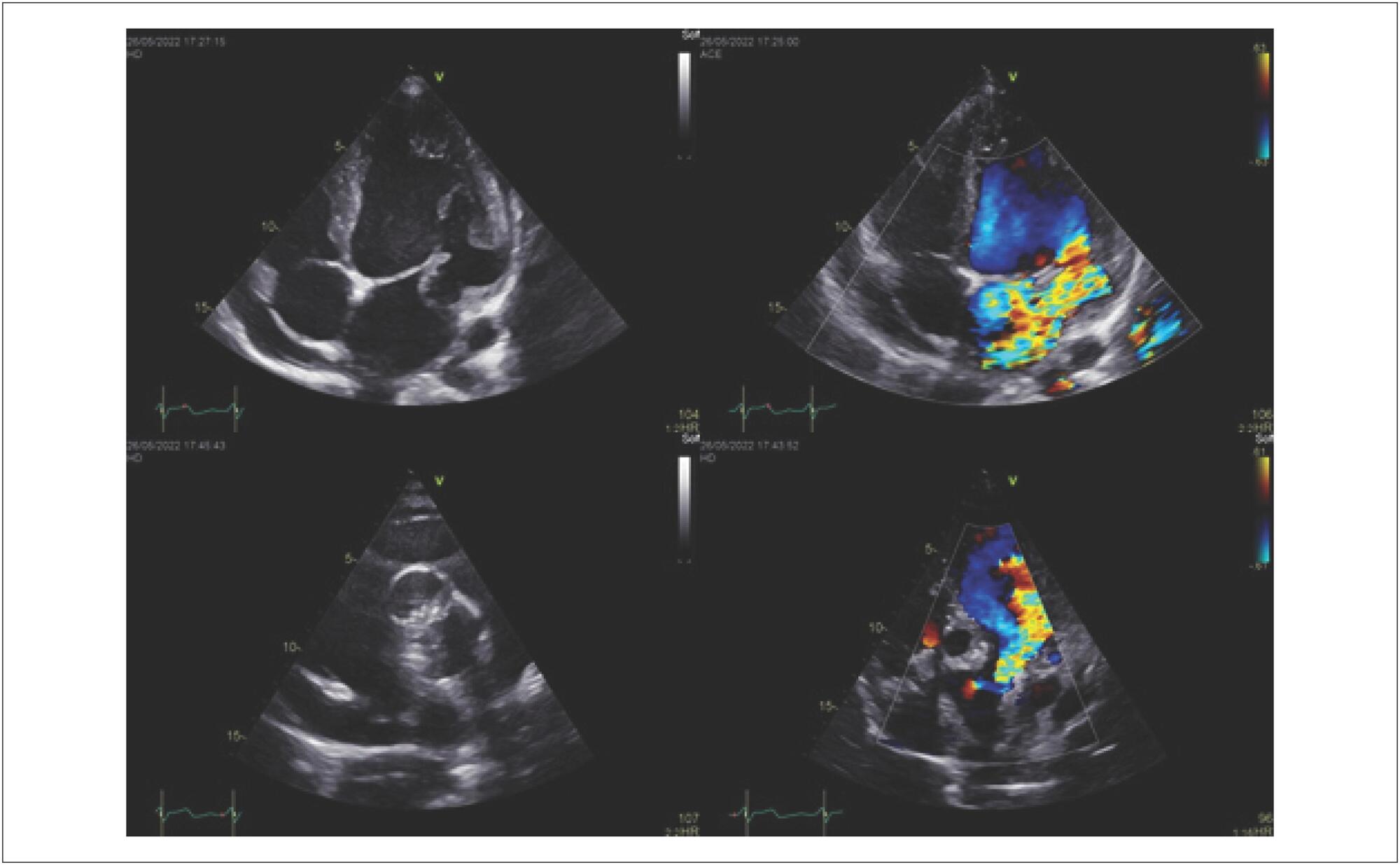 Idiopathic Mitral and Aortic Subvalvular Aneurysm in a Young Patient